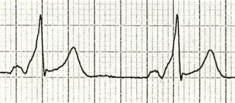 Delta Wave • LITFL Medical Blog • ECG Library Basics