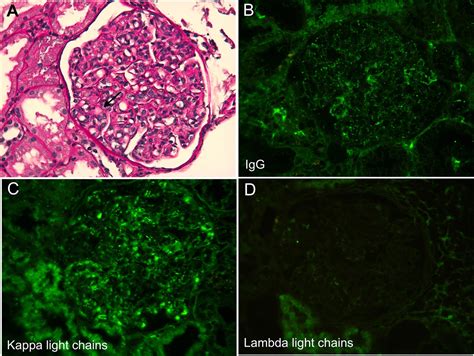 Revisiting Schnitzler syndrome: A rare severe form of acute kidney ...