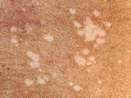 Black Fungus On Skin : Cutaneous Infections In Black Skin Springerlink ...