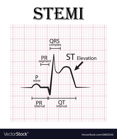 Ecg of st elevation myocardial infarction stemi vector image on vectorstock – Artofit