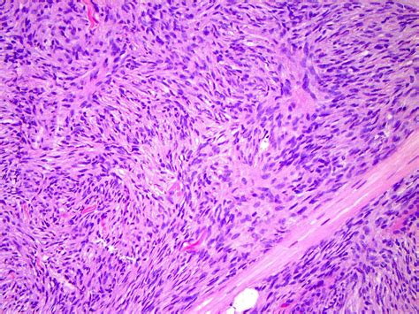 Dermatofibrosarcoma Protuberans Histology