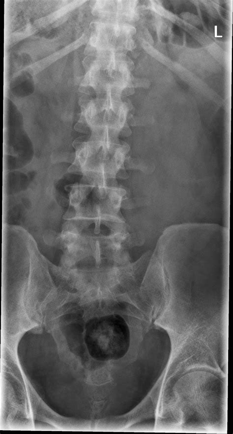 Normal Lumbosacral X Ray : Lateral lumbar radiographs. Left: hyperlordosis; middle ... : Normal ...