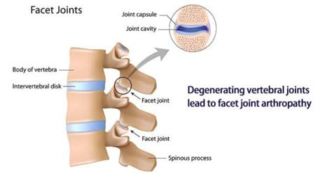 Facet Joint Arthropathy: Symptoms Causes Prevention and Treatment