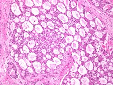 Adenoid Cystic Carcinoma - MyBioSource Learning Center