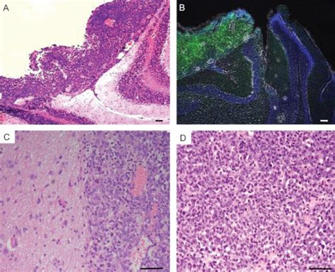 Histological characterization of brain metastatic melanoma. (A)... | Download Scientific Diagram