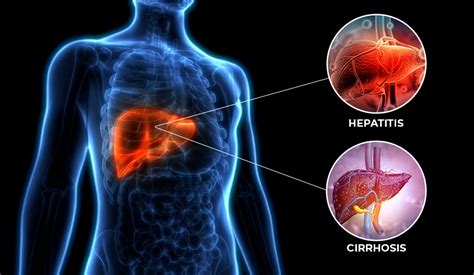 Difference Between Hepatitis and Cirrhosis - Bulat Pharmaceutical