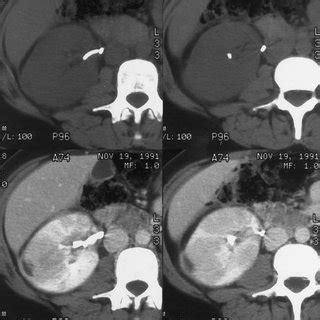 (PDF) Complications of Ureteral Stent Placement1