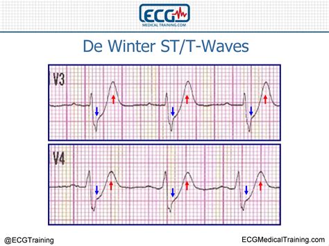 De Winter ST/T-Waves - ECG Medical Training