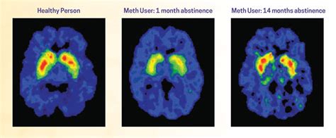 What are the long-term effects of methamphetamine misuse? | National ...