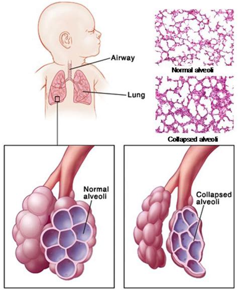 Lung Compliance and Elastance - Owlcation