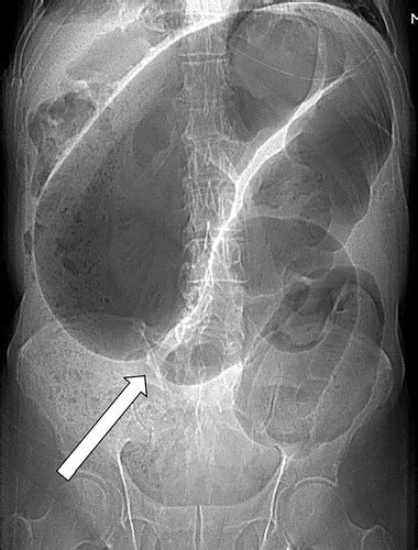 Cecal Vs Sigmoid Volvulus - Mari-Kiketi