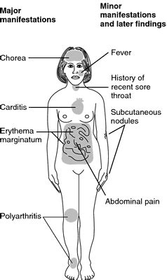 Revised Jone’s Criteria - Mnemonic | Epomedicine