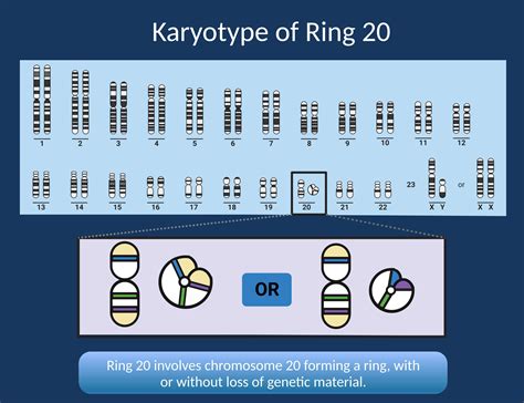 Ring Chromosome 20 – here is what you need to know in 2023 | Beyond the ...