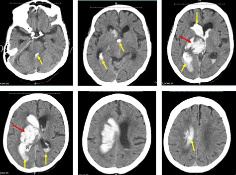 Basal ganglia hemorrhage – Radiology Cases