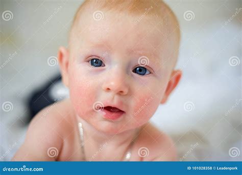 The Face of a Newborn Baby with Atopic Dermatitis Stock Photo - Image of redhead, beautiful ...