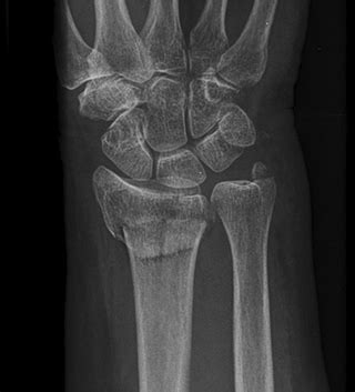 Colles Fracture | Seacoast Orthopedics & Sports Medicine, Newburyport, MA