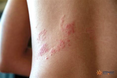 Shingles | Epiphany Dermatology