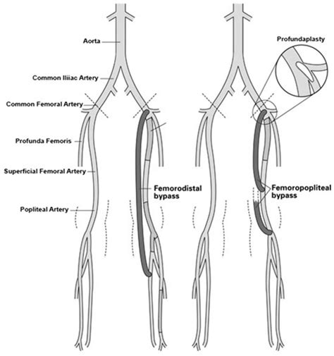 Springfield Heart Surgeons LLC - Femoral Bypass Surgery