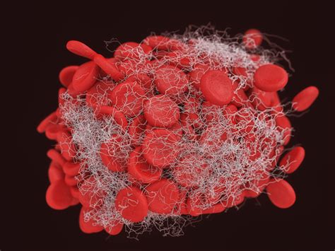 Thrombose-Therapie – einfach und risikoarm - MedMix