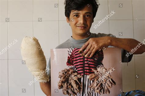 Abul Bajandar Patient Diagnosed Epidermodysplasia Verruciformis Editorial Stock Photo - Stock ...