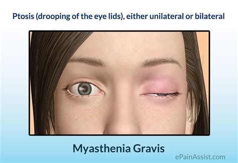 Myasthenia Gravis|Causes|Signs|Symptoms|Investigations|Treatment-Medications, Surgery