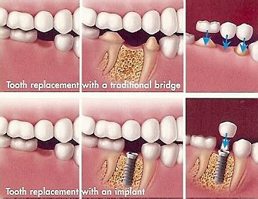 Dental Bridge Vs. Implant: Which Is Right For You? - Gorbatov Dentistry – Your Dentist in ...