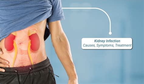 Kidney Infection - Causes, Symptoms, Treatment - Alfa Kidney Care