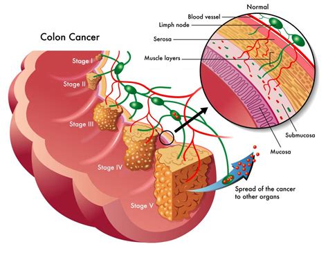 What Is the Relationship between Constipation and Colon Cancer?