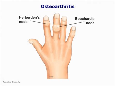 Osteoarthritis of the Fingers HANP03 - Bloomsbury Health Centre