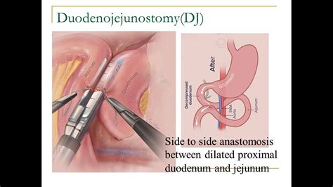 Dhaval Mangukiya: SMA syndrome: Lap Duodenojejunostomy - YouTube