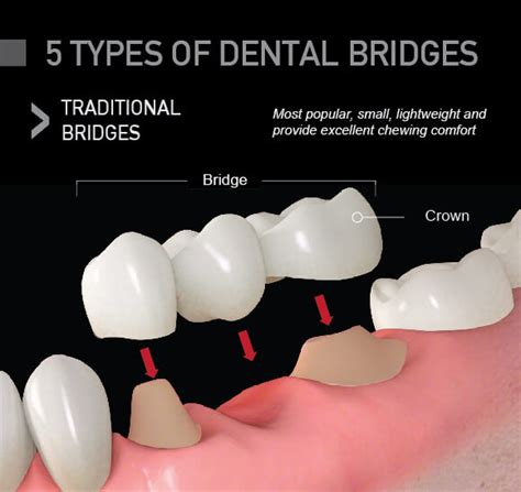 Tipos de puentes dentales: ¿Qué tipo es el mejor para mí? | Savage Rose