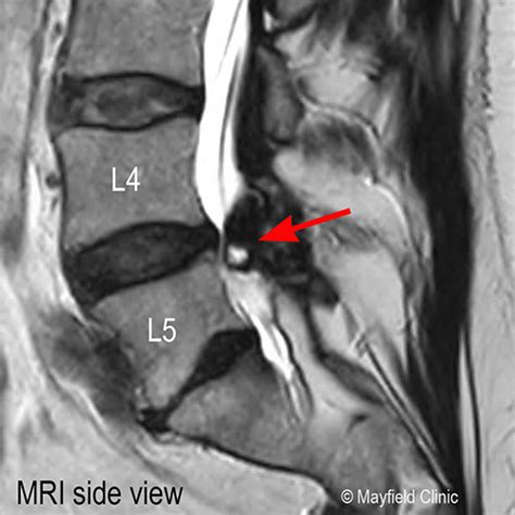 Evan's story, Synovial cyst | Mayfield Brain & Spine