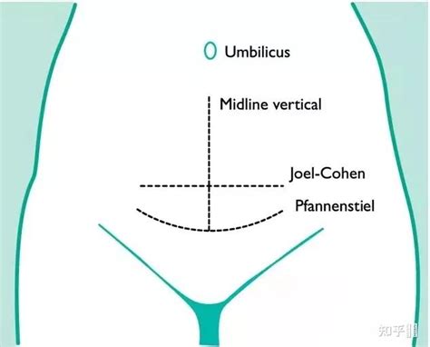 为什么剖腹产是在产妇的肚子上横着切一刀，而不是竖着切？ - 知乎