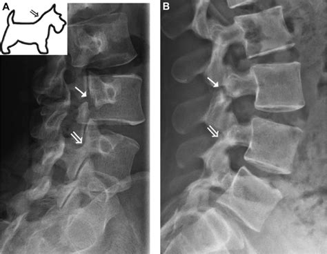 Right-sided pars interarticularis defect at L3 (closed arrow) on... | Download Scientific Diagram