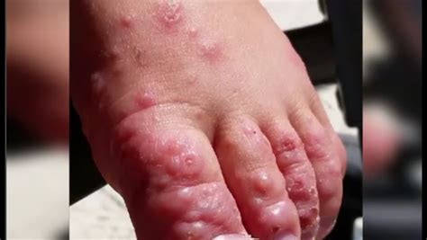 Hand, foot and mouth disease very contagious, affects kids 5...