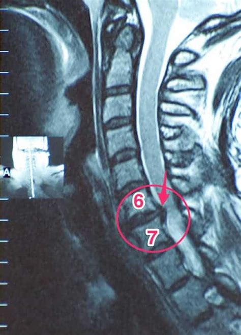 Mom Experiencing Life Again with Cervical Disc Arthroplasty