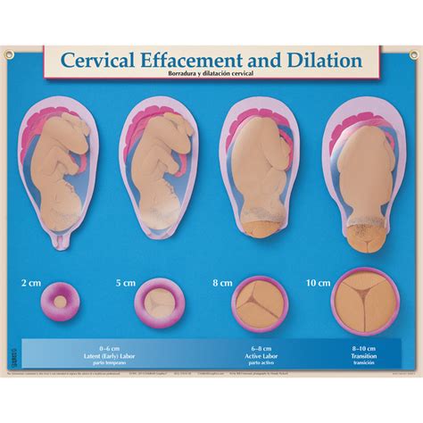 Cervical Effacement & Dilation Chart | Childbirth Graphics