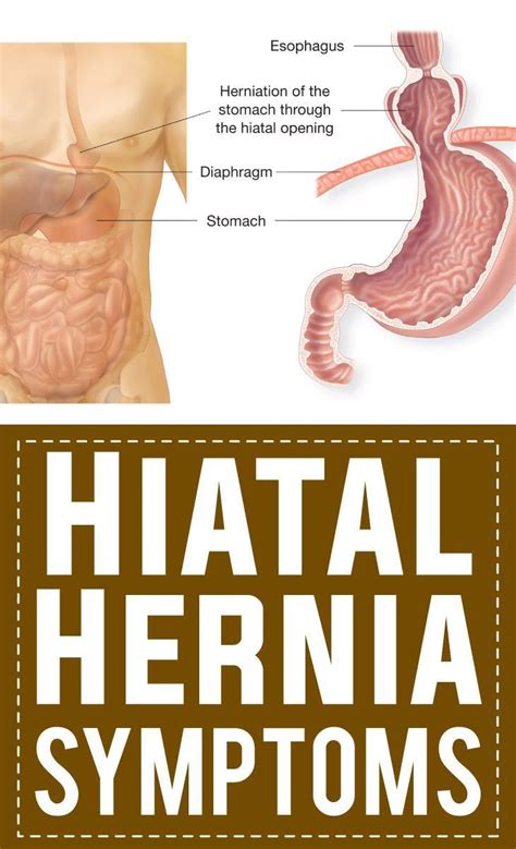 Hiatal Hernia Symptoms | Pin Remedies | Hernia symptoms, Epigastric ...