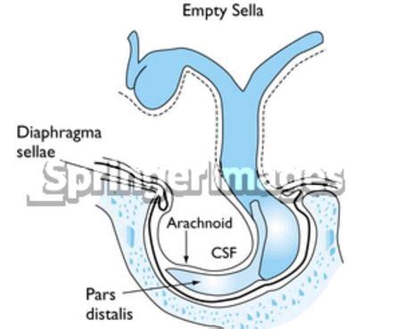 Sella Turcica - Bone, Function, Site, Location, Anatomy, Empty Sella