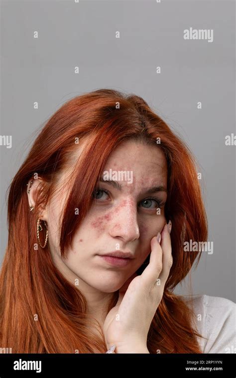 Young woman with acute skin rash on her face. Dermatological problems ...