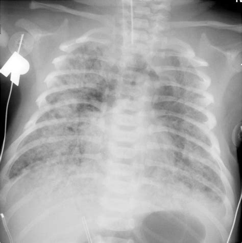 Meconium aspiration syndrome - The Clinical Advisor