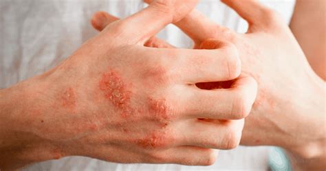 Eczema Treatment: 13 Home Remedies for Eczema - Dr. Axe