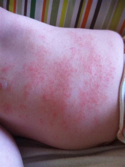 baby egg allergy rash pictures - Divina Cleary