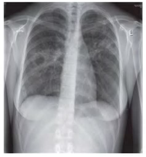 Initial Chest Xray Showing Old Scar Of Pulmonary Tuberculosis Without