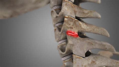 Cervical Facet Syndrome - ShimSpine