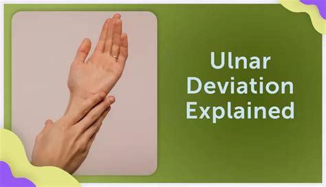 Ulnar Deviation Explained | myRAteam