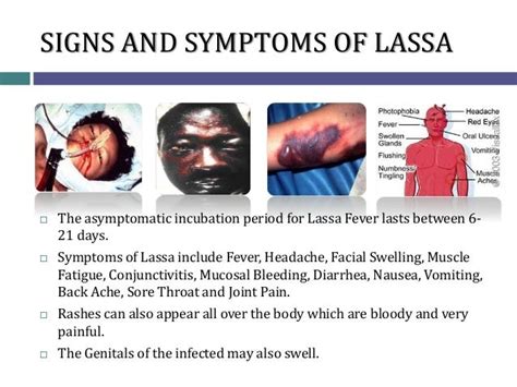 UNDERSTANDING LASSA FEVER