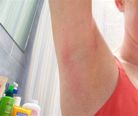 Underarm Rash - Pictures, Treatment, Symptoms, Causes