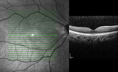 Ocular oncology : Dr Sunil Warrier