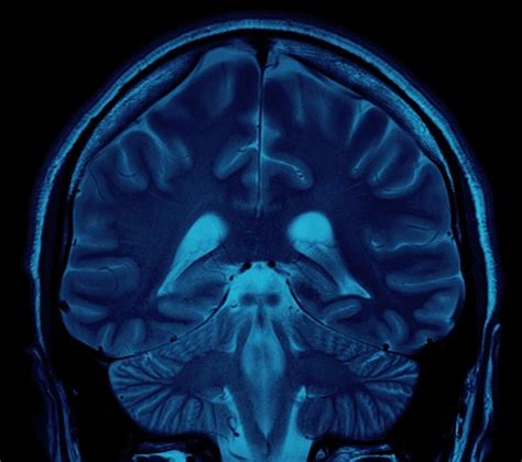 What Is a Low-Dose CT Scan? | Melbourne Radiology